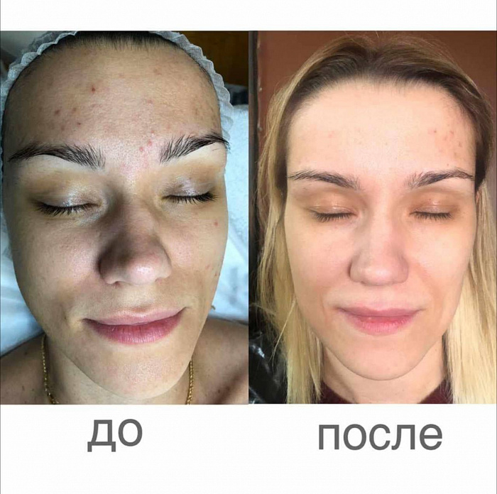 Как убрать Акне на лице?